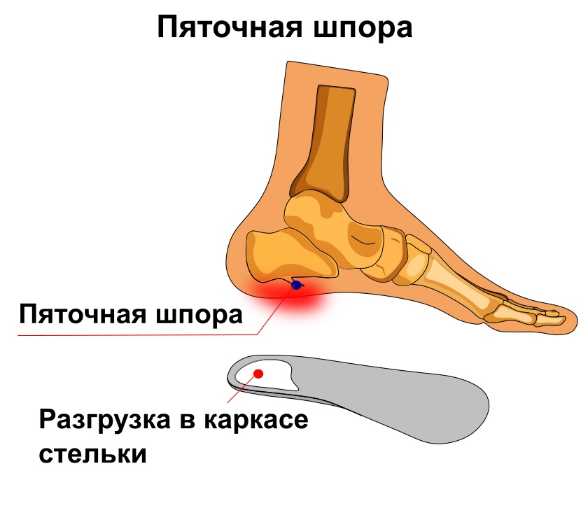 Пяточная шпора минск. Подошвенный (плантарный) фасциит. Пяточная шпора причины.