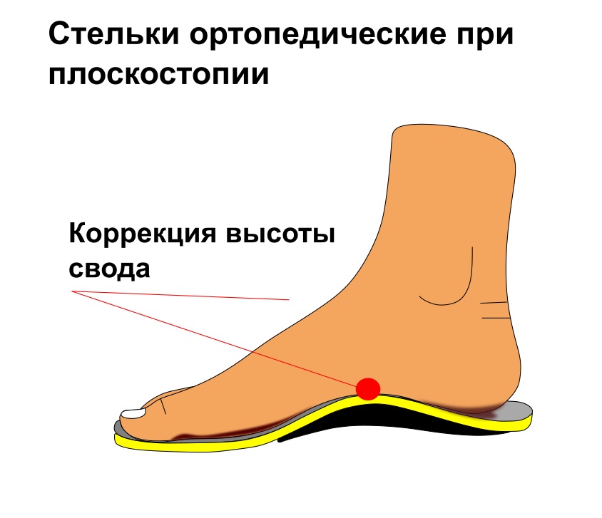 Обувь плоскостопия